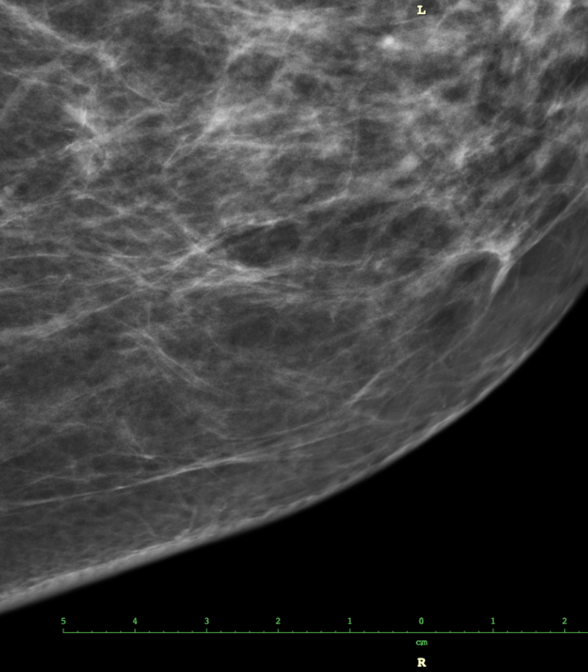 Breast cancer is influenced by a factor that is often overlooked